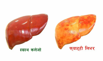 किन जम्छ कलेजोमा बोसो? के-के समस्या निम्त्याउँछ? कसरी बच्ने?